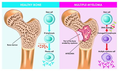 Medical illustration shows the difference between healthy bone and one that is eroded by multiple myeloma, which is caused by damaged DNA.