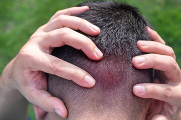 man holding his head with both hands because of the pain caused by a hornet or bee sting - obrazy, fototapety, plakaty