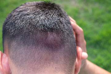 Obraz premium man is holding his head in pain from a hornet or bee sting.