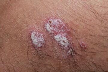 problem skin psoriasis on the body. Psoriasis is an autoimmune disease that affects the skin...