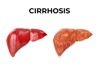 Liver cirrhosis is a chronic inflammation of the liver, a fibrous tissue replaces normal liver tissue, blocking blood flow