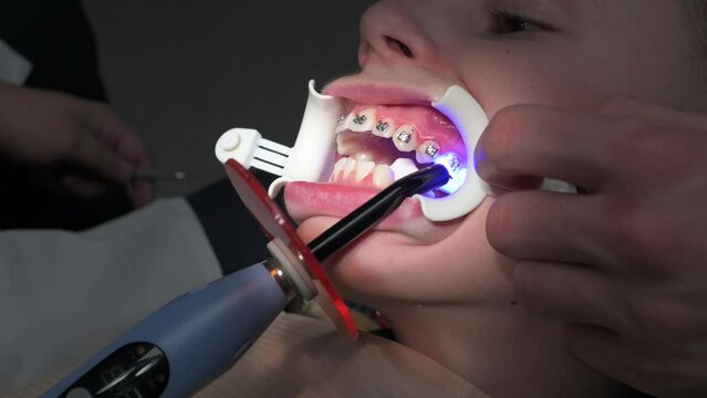 The use of ultraviolet light during the installation of braces, braces on the upper jaw crooked teeth.