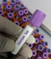 Blood sample for Selenium test, to determine a selenium deficiency or toxicity.