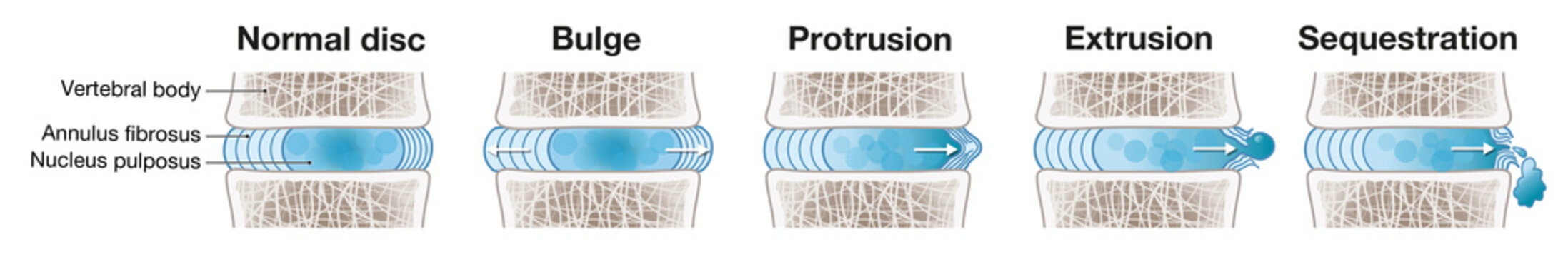 Herniated Disc Schema. Normal Disc. Bulge. Protrusion. Extrusion. Sequestration. Labeled Illustration_4