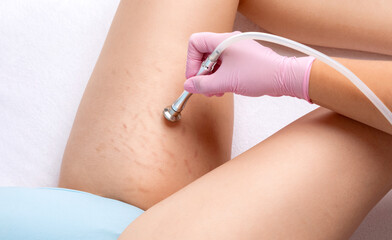 Microdermabrasion procedure on the thighs of a young woman after weight loss. Treatment of skin...