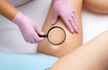 The doctor examines the inside of the thighs of a woman who has stretch marks on her skin....