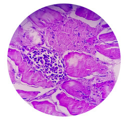 Microscopic view of histological tissue study showing Rhabdomyoma.