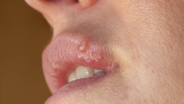 CLOSE UP: Detail view of upper lip affected with blister caused by herpes simplex. Part of a young woman's face with a virus herpes simplex on lips. Unrecognizable person suffering from labial herpes.