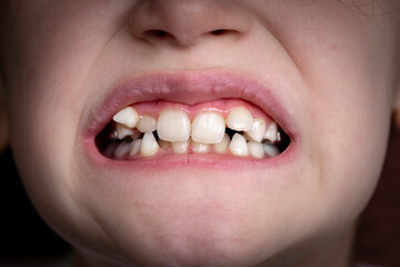 A young girl smiles and shows her crooked teeth. Mouth close-up.