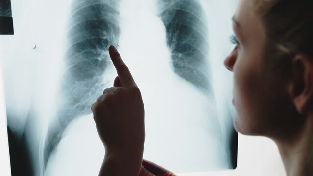 Young female doctor looking at a chest xray photograph pointing with her finger at ribs. High quality 4k footage