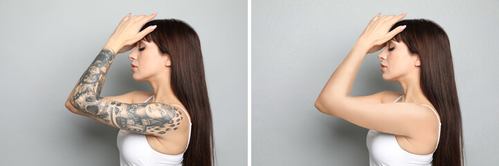 Woman before and after laser tattoo removal procedure on light grey background. Collage with...