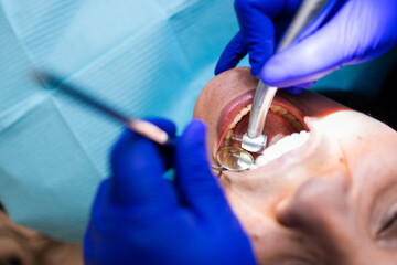 Unrecognizable dentist doing a routine dental checkup using an engine drill tool. 