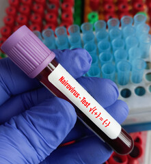 Blood sample for Nairovirus test, Congo hemorrhagic fever, Nairobi sheep disease virus, CCHF, Tick borne virus, Nosebleed fever.