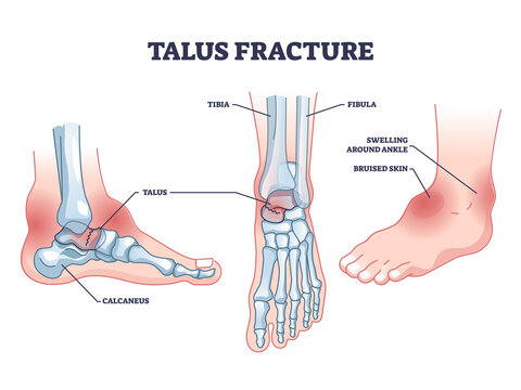 Talus fracture as broken leg with swelling ankle symptom outline diagram. Labeled educational scheme with medical bone trauma vector illustration. Human leg foot anatomical structure with painful part