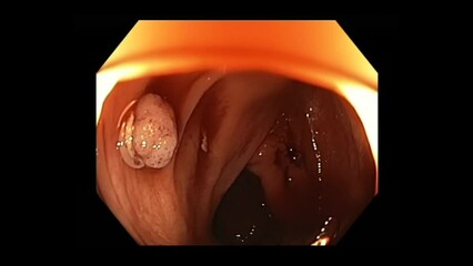 Precancerous Polyp In The Colon Found And Removed During Colonoscopy Procedure For Analysis. macro