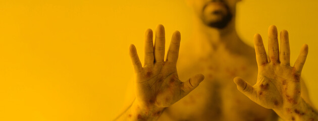 Male hands affected by blistering rash because of monkeypox or other viral infection on yellow background, wide banner.