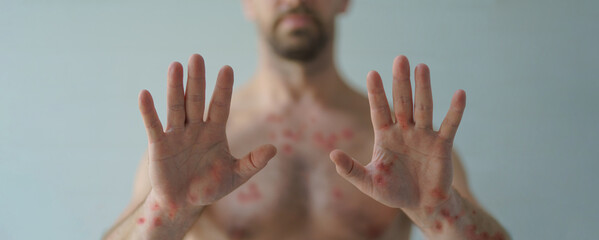 Male hands affected by blistering rash because of monkeypox or other viral infection on white background