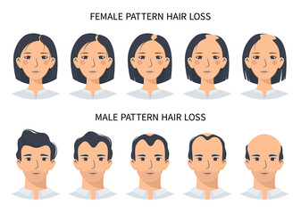 Hair loss stages, androgenetic alopecia male and female pattern. Steps of baldness vector infographic in a flat style with a man and a woman. Changing the hairline on the scalp - obrazy, fototapety, plakaty
