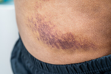 Asian woman dark bruise on the buttocks from a slip accident in the bathroom. - obrazy, fototapety, plakaty