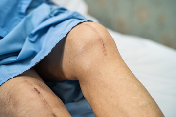 Asian senior or elderly old lady woman patient show her scars surgical total knee joint replacement Suture wound surgery arthroplasty on bed in nursing hospital ward, healthy strong medical concept.