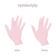 Skin and bone syndictalia, fusion of fingers. genetic disease. Medical poster. Vector illustration