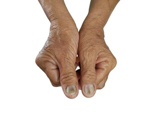 Diabetes foot Infected wound of medical dressing wound infection treatment patient diabetes of leg...