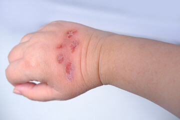 close up of female hand. Dermatology concept human hands with skin with cracks and wounds, skin...