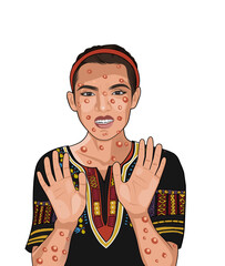 White woman face affected by monkeypox.