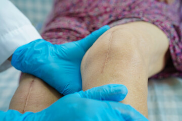 Asian elderly woman patient with scar knee replacement surgery in hospital. - obrazy, fototapety, plakaty
