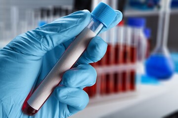 Blood sample of patient for test in laboratory. Doctor with Blood tube test in lab