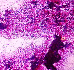 Hepatocellular carcinoma(hepatoma), positive malignant cells. Microscopic show cellular material, atypical hepatocytes, pleomorphism with prominent nucleoli, background inflammatory cells,blood.