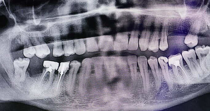 an x-ray photograph of human teeth emerges from the blur. dental theme and concept. High quality 4k footage
