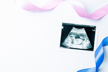Ultrasound photo pregnancy baby. Blue, pink ribbon with ultrasound pregnancy picture on white...