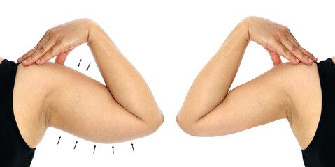 Comparison female arm fat and slimming size before and after losing weight. Woman's body part...