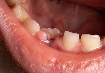 A child with an open mouth without one milk tooth in the jaw. Change of milk teeth. Bleeding gums,...
