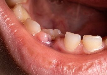 A child with an open mouth without one milk tooth in the jaw. Change of milk teeth. Bleeding gums, close-up