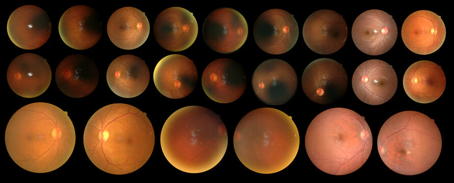 SET of Photo Madical Retina Normal isolated on black background.Diabates retinopathy.Human eye anatomy taking images with Mydriatic Retinal cameras.Madical EYE health Concept.