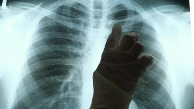 Doctor studying fluorography of patient's lungs, close-up