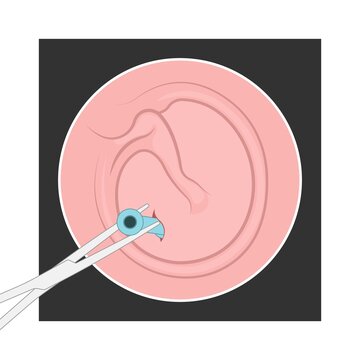 Perforated eardrum tube surgical drain Otitis media ear wax Hole repair sound canal tear pain pus bloody Hearing loss injury Middle fluid water Loud blasts microscopic acute bone cotton swab otoscopic