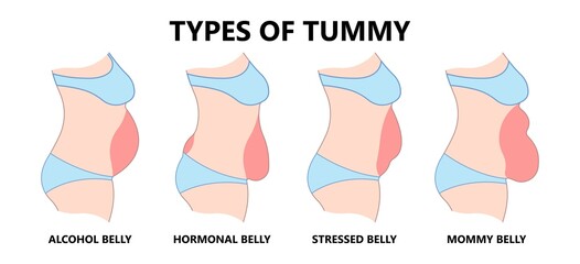 Diastasis Recti six pack separation belly rectus Linea alba abdominal surgical Tummy Tuck skin fat loss c section Ovary Over consuming Bloated Stressed Out childbirth