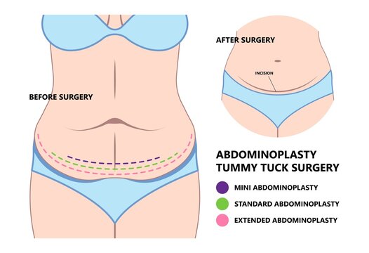 Diastasis Recti six pack separation belly rectus Linea alba abdominal surgical Tummy Tuck skin fat loss c section Ovary Over consuming Bloated Stressed Out childbirth