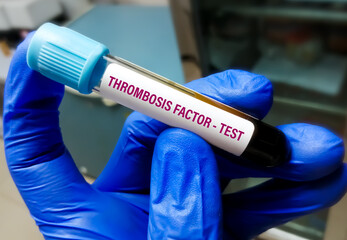 Doctor holding Blood tube for Thrombosis Risk factor test. Bleeding disorder.