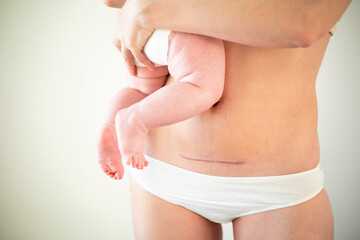 Mom's abdomen after cesarean section. Scar seam. A young mother holds the baby in her arms. Real motherhood. Lifestyle - obrazy, fototapety, plakaty