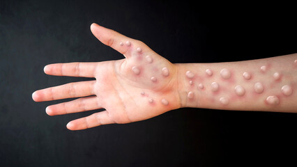 MONKEYPOX. The arm is blistered from monkeypox. Virus, epidemic, disease. Black background. - obrazy, fototapety, plakaty