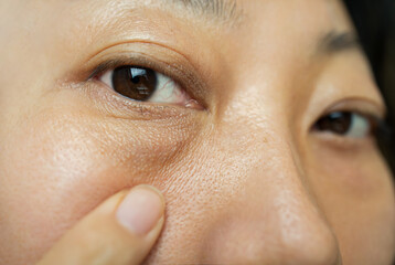 Asian woman have facial wrinkles, large bags under their eyes.