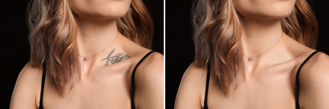 Woman before and after laser tattoo removal procedure on black background, closeup. Collage with photos, banner design
