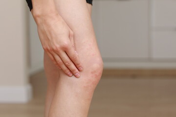 skin allergies, legs skin women. Closeup of red pustules on a knee, an allergic reaction caused by...