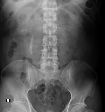 Nephrolithiasis,   kidney stones  abdomen x ray