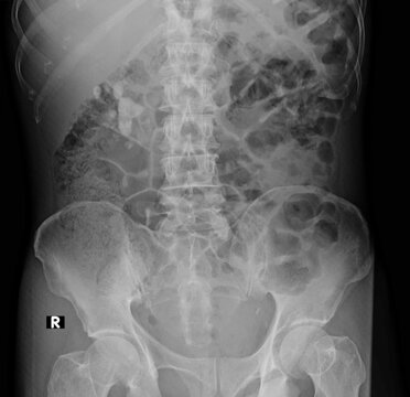 Nephrolithiasis,   kidney stones  abdomen x ray