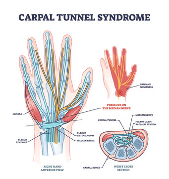 Carpal tunnel syndrome with median nerve pressure disease outline diagram. Labeled educational orthopedic condition from working with non ergonomic computer vector illustration. Occupational arm pain.